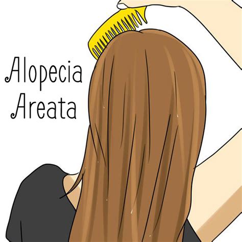 Topical photochemotherapy for alopecia areata. Wat eet je dan wel? - Geen haar op mijn hoofd: alopecia ...