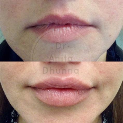 How much arnica to take before fillers. Lip Enhancement - Dr Anita Dhunna | Dr Anita Dhunna
