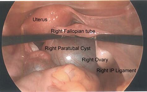 Fallopian Tube Cyst