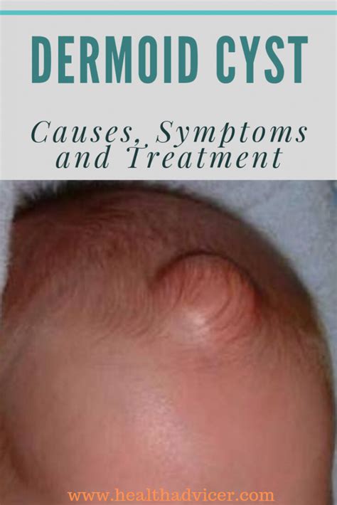 Dermoid Cyst Causes Picture Symptoms And Treatment