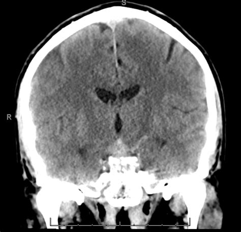 Subarachnoid Hemorrhage Radiology Case