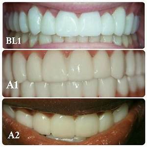 Image Result For Bl1 Dental Shade Celebrity Smiles Cosmetic Dentist