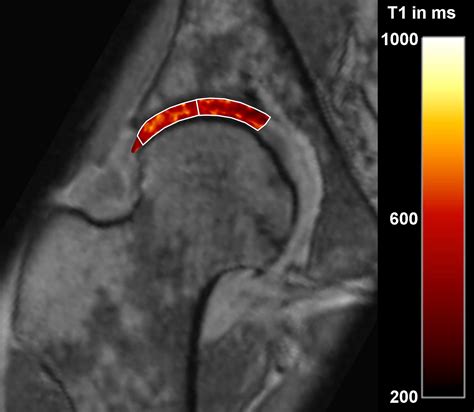 Patterns Of Joint Damage Seen On Mri In Early Hip Osteoarthritis Due To