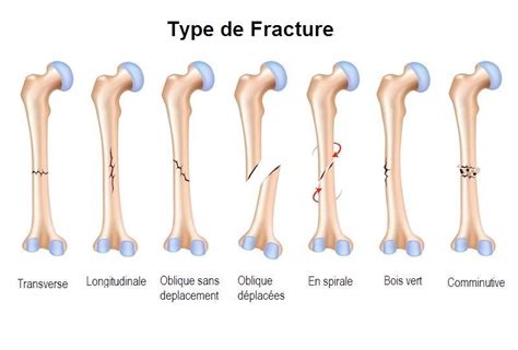 Type de fracture... | Bone fracture, Types of fractures, Types of bones