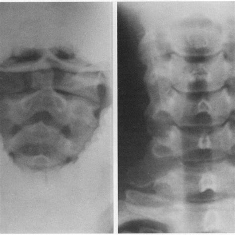 Antero Posterior Radiographs Of The Cervical Spine Of The 32 Year Old