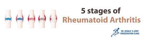 Rheumatoid Arthritis Stages And Treatment Dr Desale