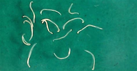 Teen Gets Gruesome Hookworm Infection After Friends Bury Him In The