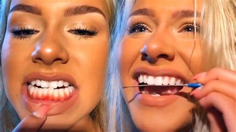Girls On Tik Tok Are Destroying Their Teeth For Beauty Youtube