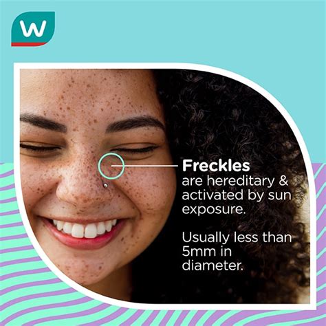 Freckles Causes Types And When To See A Doctor Watsons Singapore