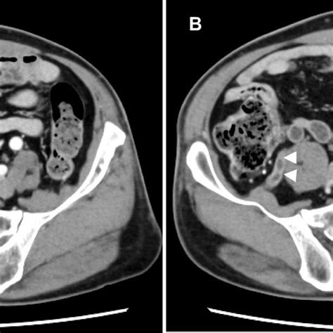 Abdominal Computed Tomography Ct Scan Enhanced Abdominal Ct