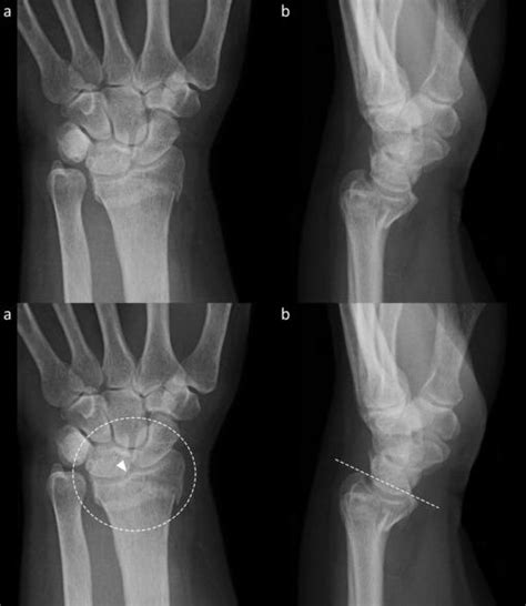 Interpreting The Wrist Radiograph In Adult Trauma The Bmj