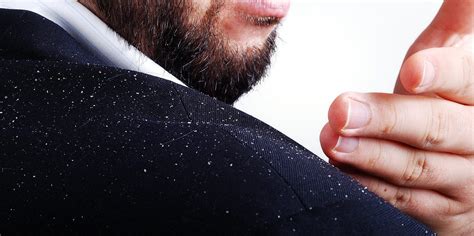 Dandruff Symptoms, Triggers, and Location: How to Prevent and Treat the ...