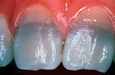 What Is The Cause Of The Tooth Discoloration Seen Here Duke Health
