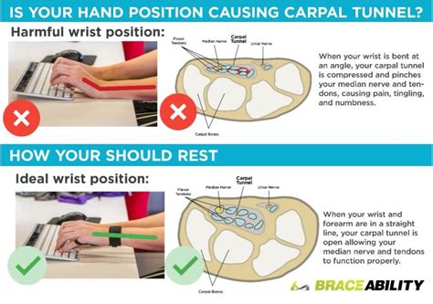 Carpal Tunnel Syndrome Facts Treatment And Prevention Jada Solutions