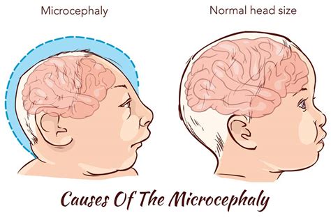 Microcephaly Causes Symptoms And Treatment Options 99 Health Ideas