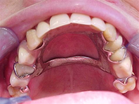 Front Partial Dentures