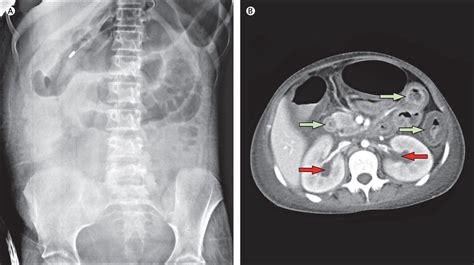 An unusual medical cause of abdominal pain diagnosed by urological abnormalities - The Lancet
