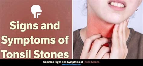 Tonsil Stones Symptoms