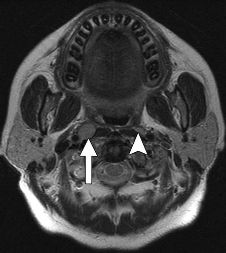 Radiologic Criteria Of Retropharyngeal Lymph Node Metastasis In