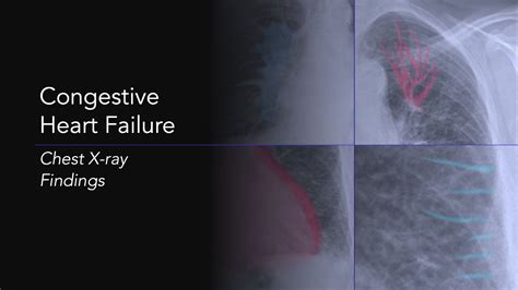 Congestive Heart Failure Explanation Of Chest X Ray Findings YouTube