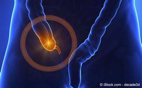 Informieren sie sich bei hirslanden über symptome die blinddarmentzündung (appendizitis) ist eine entzündung des wurmfortsatzes (appendix) des. Blinddarmentzündung | Meine Gesundheit