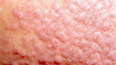 Types Of Eczema Contact Dermatitis Gladskin