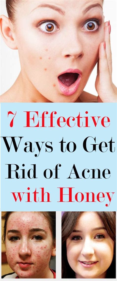 7 Effective Ways To Get Rid Of Acne With Honey How To Get Rid Of Acne