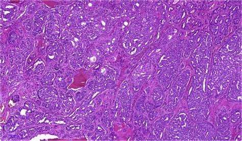 Salivary Gland Tumours Update On Molecular Diagnostics Diagnostic