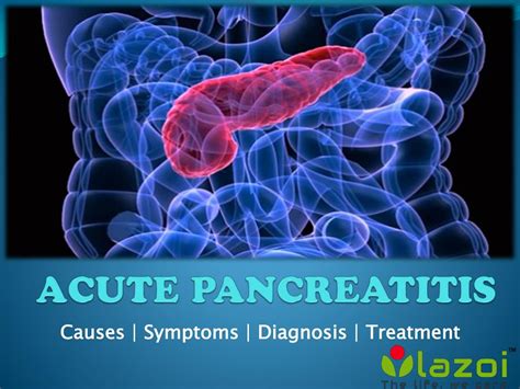 PPT Acute Pancreatitis Causes Symptoms And Treatments PowerPoint