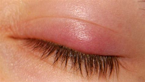 Chalazion Symptoms Pictures Causes And Treatment