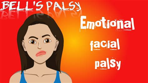 Bells Palsy Emotional Facial Palsy Youtube