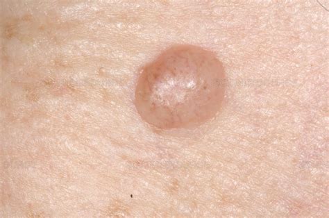 Are Moles That Stick Up More Likely To Become Melanoma Scary Symptoms
