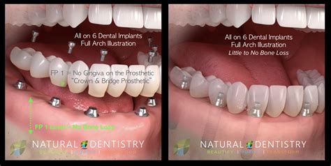 Implant Supported Full Arch Restorations