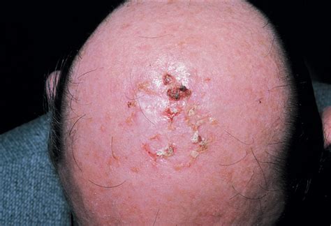 Erosive Pustular Dermatosis Of The Scalp Dermatology Jama