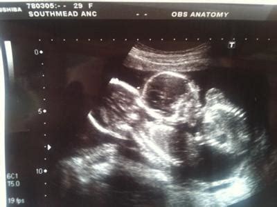 My Mono Mono Twin Girls at 19 Week Ultrasound