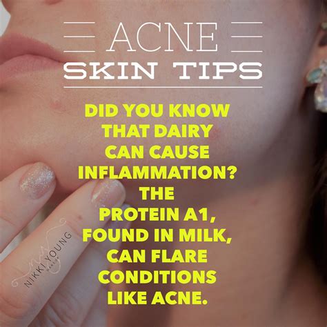 How to get rid of acne naturally: acne skin tips | Skin tips, Acne skin, Acne