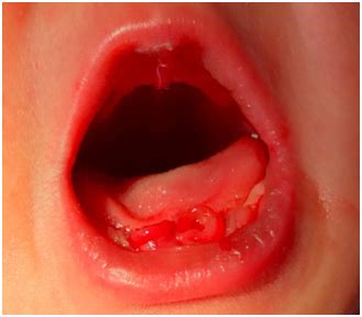 Natal teeth and neonatal teeth are rare occurrences. Natal Teeth - A Case Report with Decision Support System