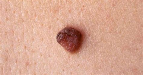 Dalam istilah medis, tahi lalat disebut sebagai nevus. Ciri-ciri Tahi Lalat yang Berbahaya | Medkes
