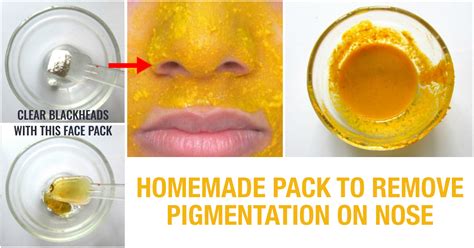 Diy Easy Steps To Remove Blackheads And Nose Pigmentation Quickly