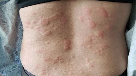 Is Liver Disease Causes Itchy Skin Danger Diag