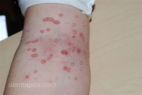molluscum contagiosum pictures in hr of this skin disease