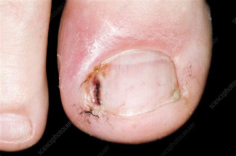 Infected Ingrowing Toenail Stock Image C0033000 Science Photo