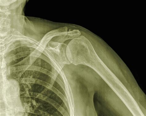 Acromioclavicular Ac Joint Arthritis What To Know