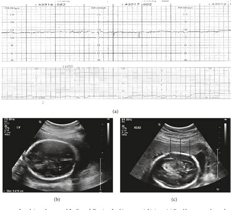 Figure 1 From Delayed Appearance Of A Traumatic Fetal Intracranial
