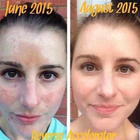 Melasma Treatment Fighting Brown Spots On Your Skin From The Inside