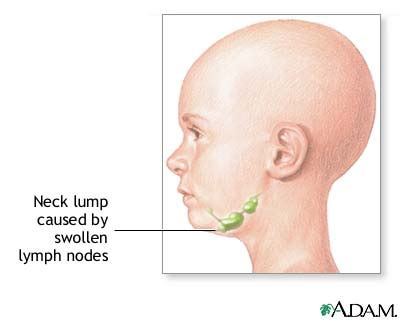 I didn't know what to do or where to go. Neck lump. Causes, symptoms, treatment Neck lump