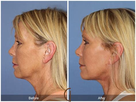 Facelift Fifties Before And After Photos Patient 54 Dr Kevin Sadati