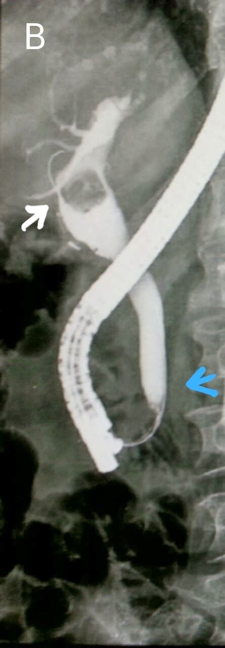 Ercp And Egd Stone Extraction Impeded By Infra Diverticular Ampulla And