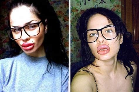 Russian Woman Gets Lip Injections To Look Like Jessica Rabbit Ybmw