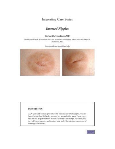 Interesting Case Series Inverted Nipples Eplasty